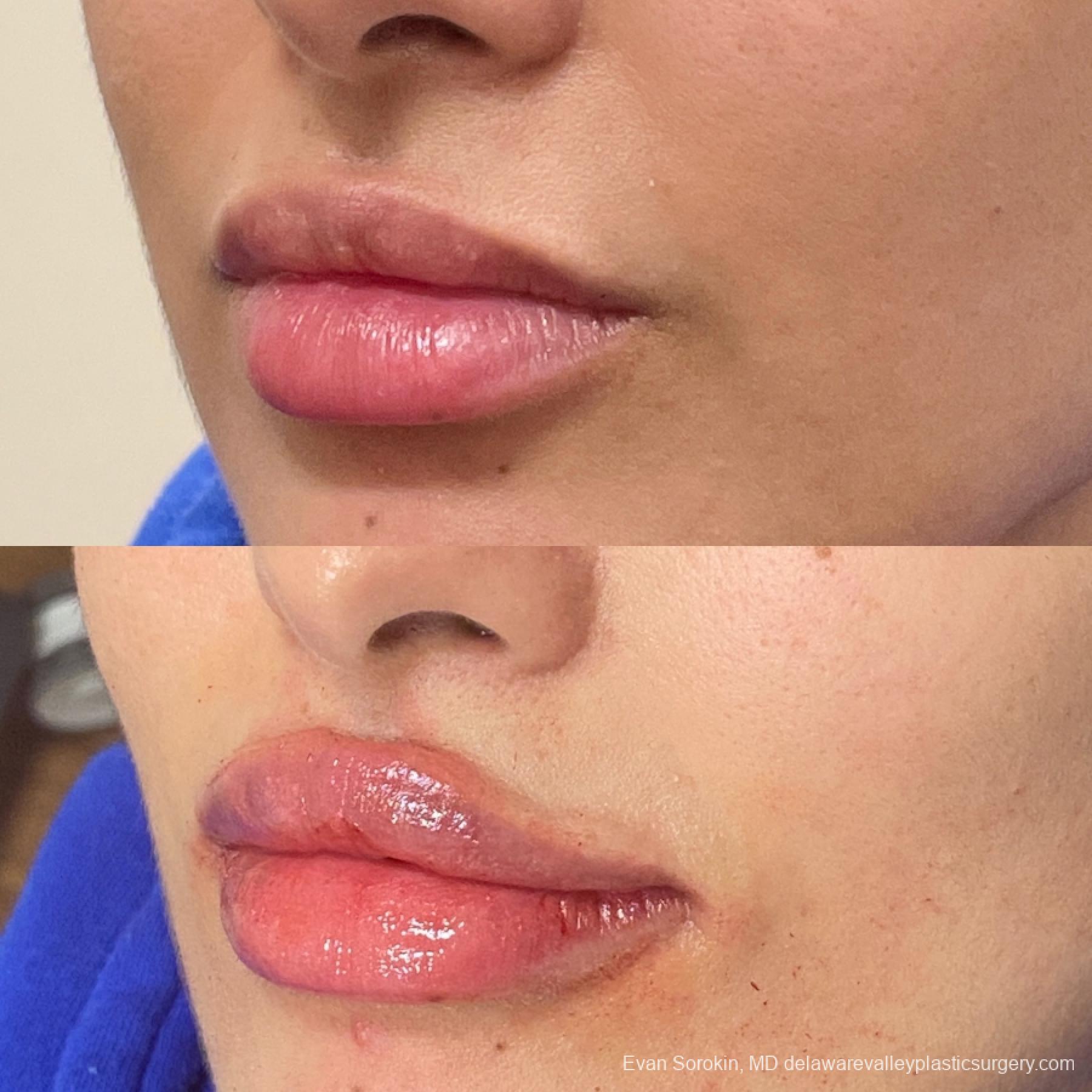 Fillers: Patient 35 - Before and After 3