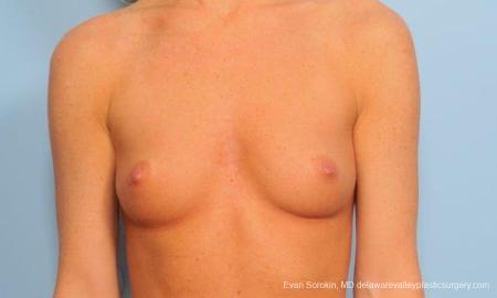 Philadelphia Breast Augmentation 9179 - Before Image 1