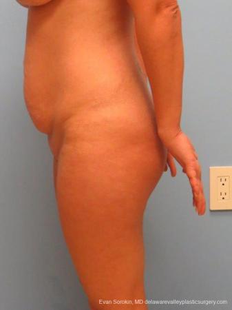 Philadelphia Abdominoplasty 9460 - Before and After Image 5