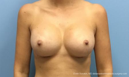 Philadelphia Breast Augmentation 12514 - After Image 1
