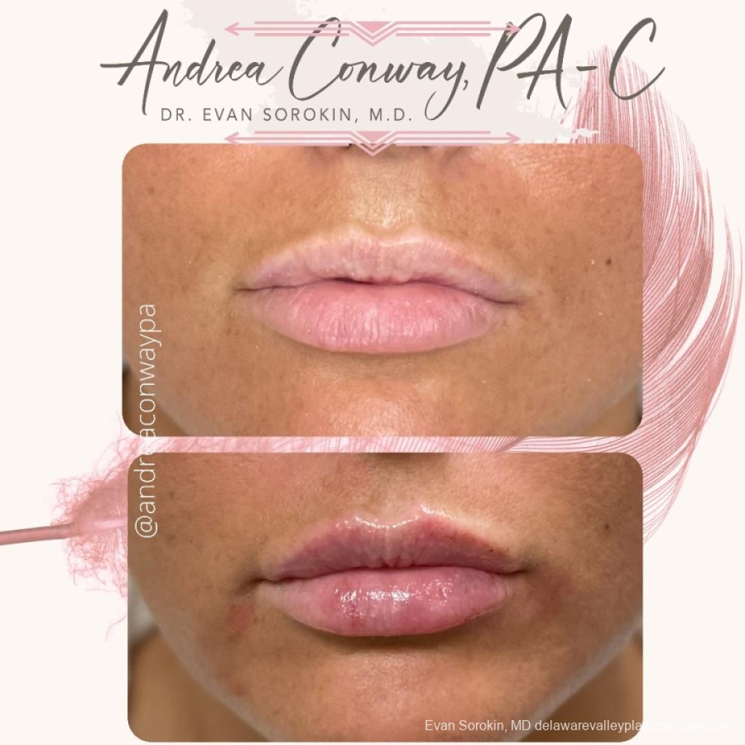Lip Filler: Patient 25 - Before and After 1