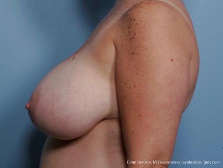 Philadelphia Breast Reduction 8703 - Before Image 4