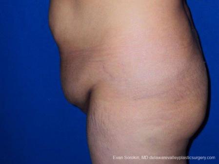 Philadelphia Abdominoplasty 9471 - Before and After Image 5