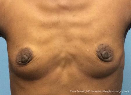 Philadelphia Breast Augmentation 13072 - Before 1