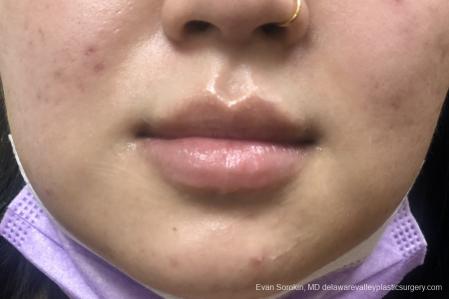 Lip Filler: Patient 15 - Before Image 1