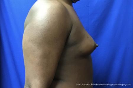 Top Surgery - Male To Female: Patient 2 - Before Image 2