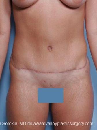 Philadelphia Abdominoplasty 8698 - After Image 1