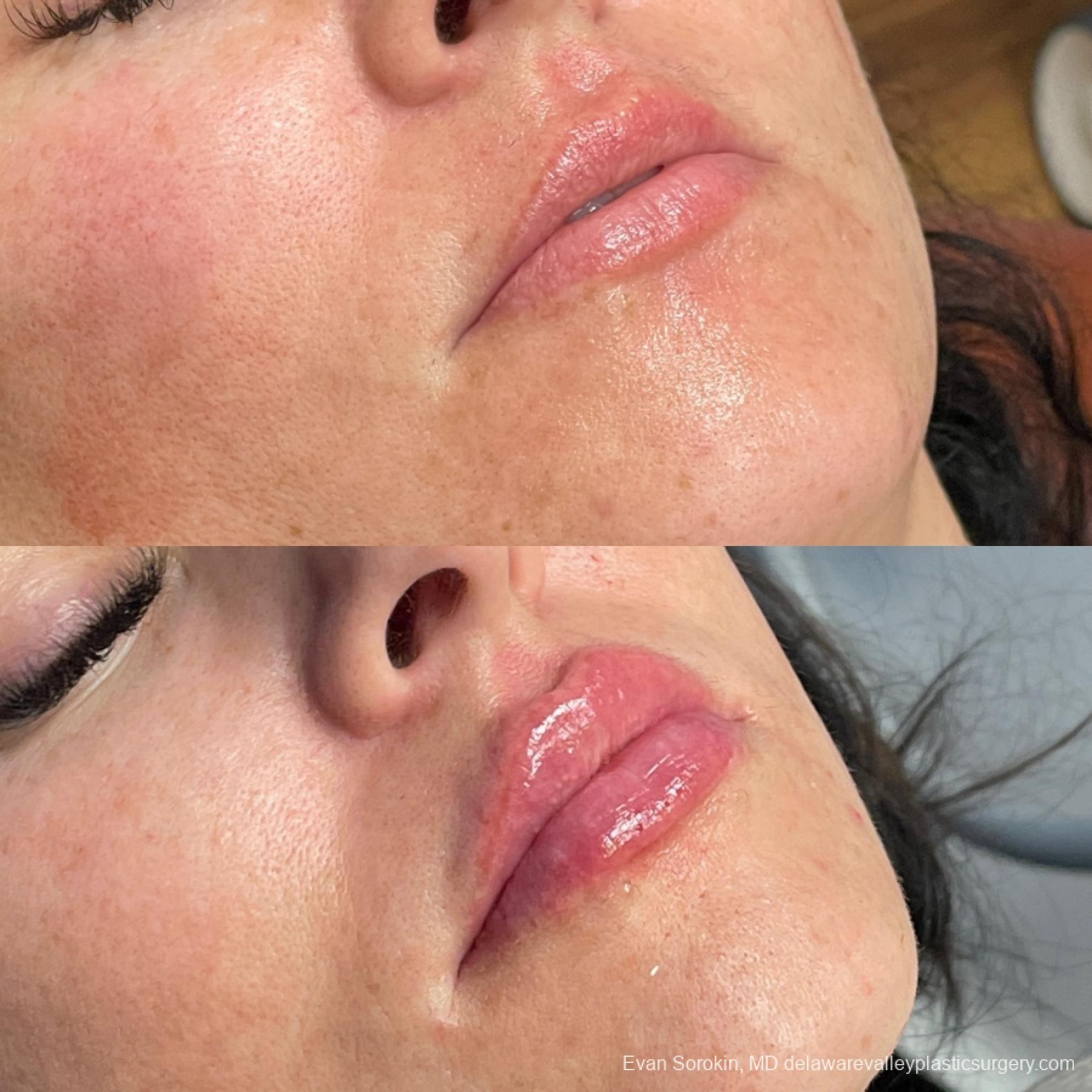 Lip Filler: Patient 65 - Before and After 2