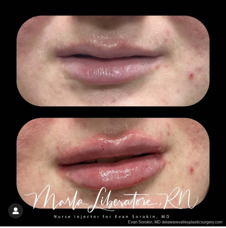 Lip Filler: Patient 21 - Before and After Image 1
