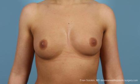 Philadelphia Breast Augmentation 8643 - Before Image 1