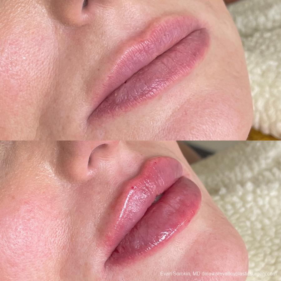 Fillers: Patient 58 - Before and After 2