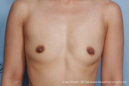 Philadelphia Breast Augmentation 8661 - Before Image 1