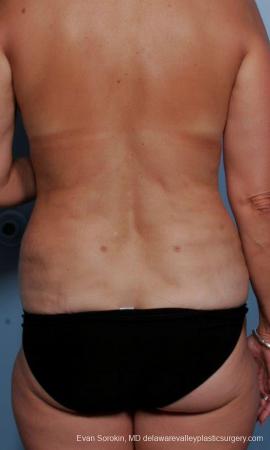 Philadelphia Liposuction 9374 - After Image 1