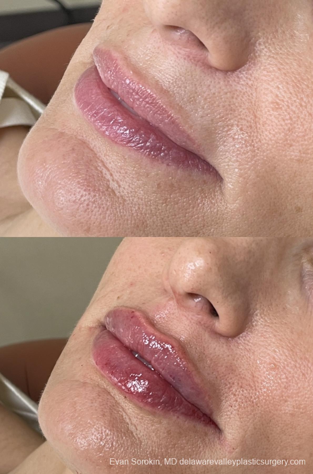 Fillers: Patient 56 - Before and After 3