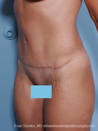 Philadelphia Abdominoplasty 8698 - After Image 2