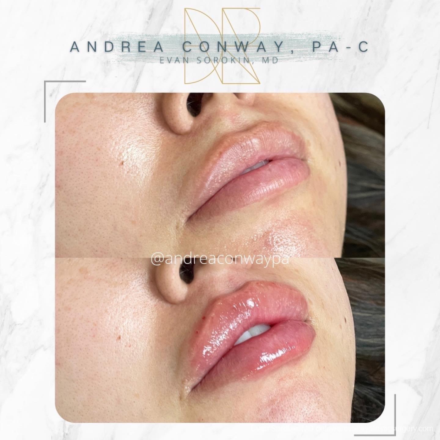 Lip Augmentation: Patient 54 - Before and After 1