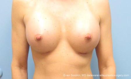 Philadelphia Breast Augmentation 9744 - After Image 1