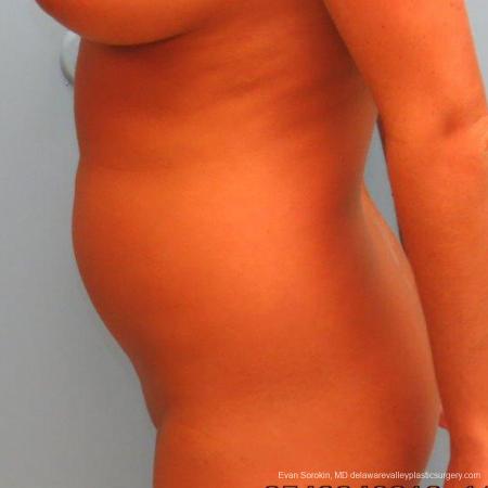 Philadelphia Liposuction 9483 - Before Image 3