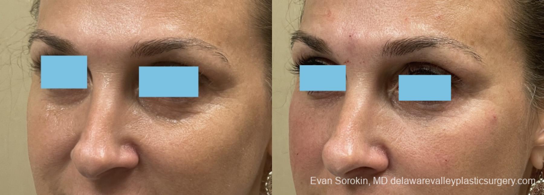 Fillers: Patient 44 - Before and After 1