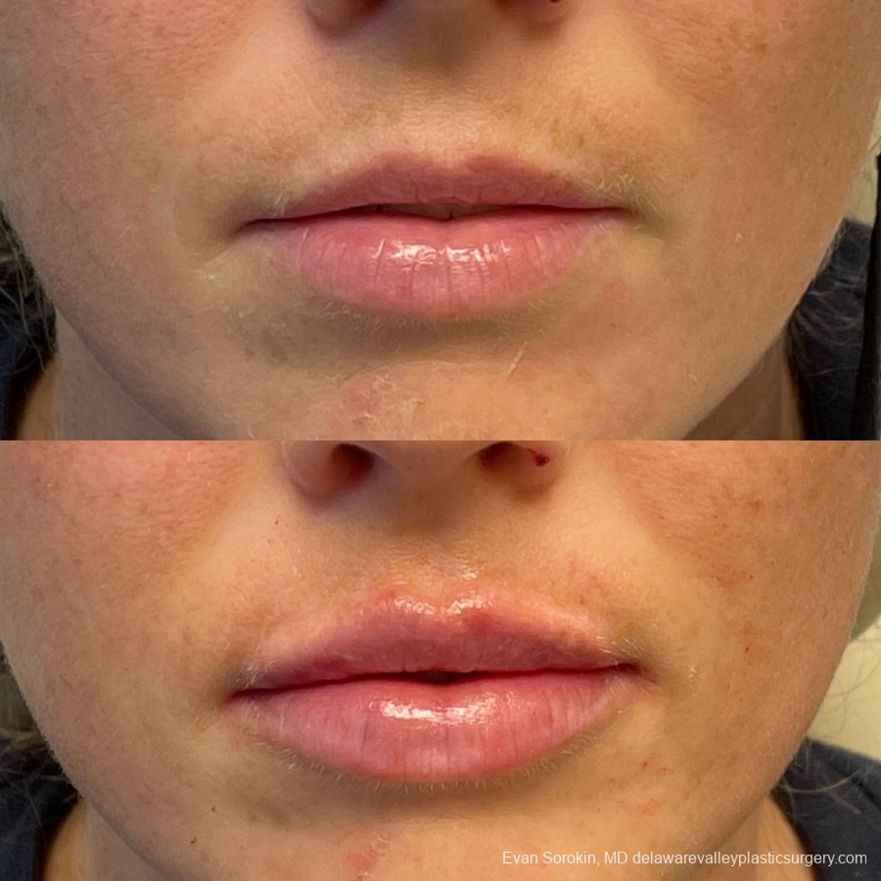 Fillers: Patient 27 - Before and After 