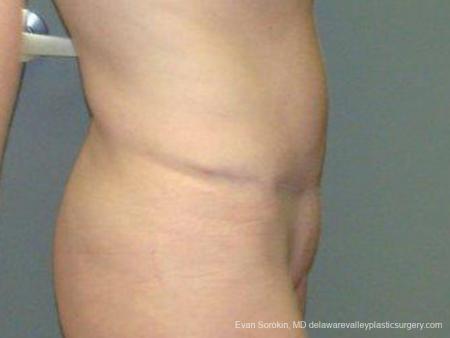 Philadelphia Abdominoplasty 9474 - After Image 3