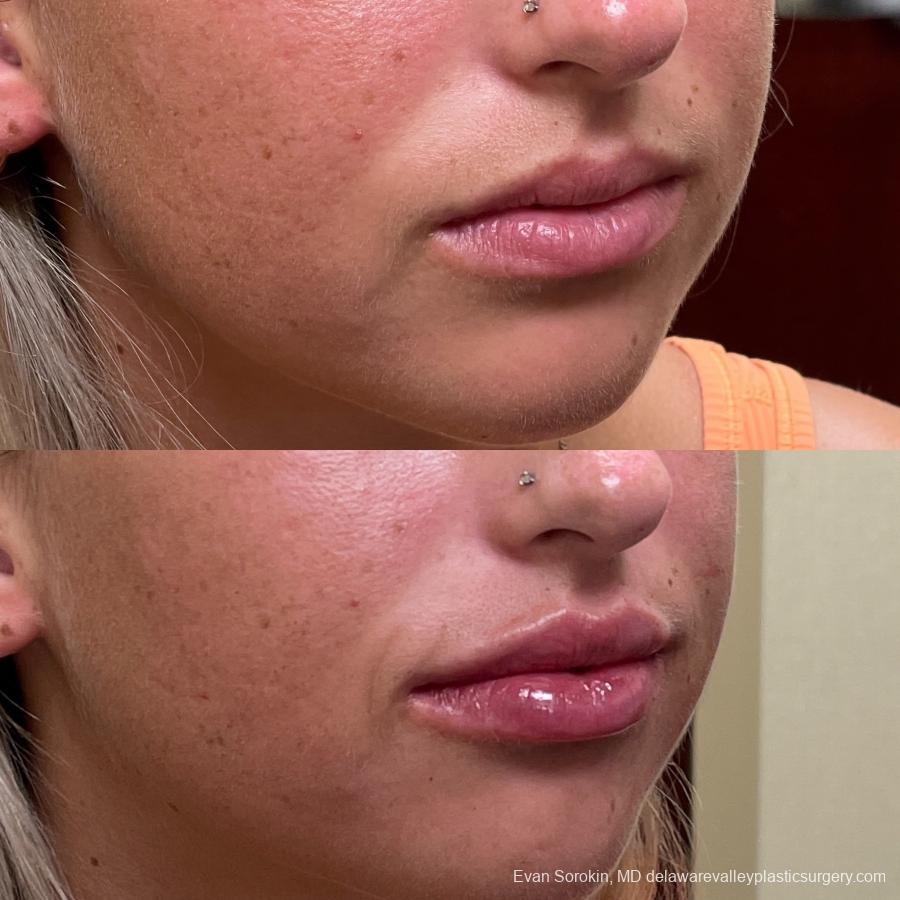 Lip Filler: Patient 27 - Before and After 2