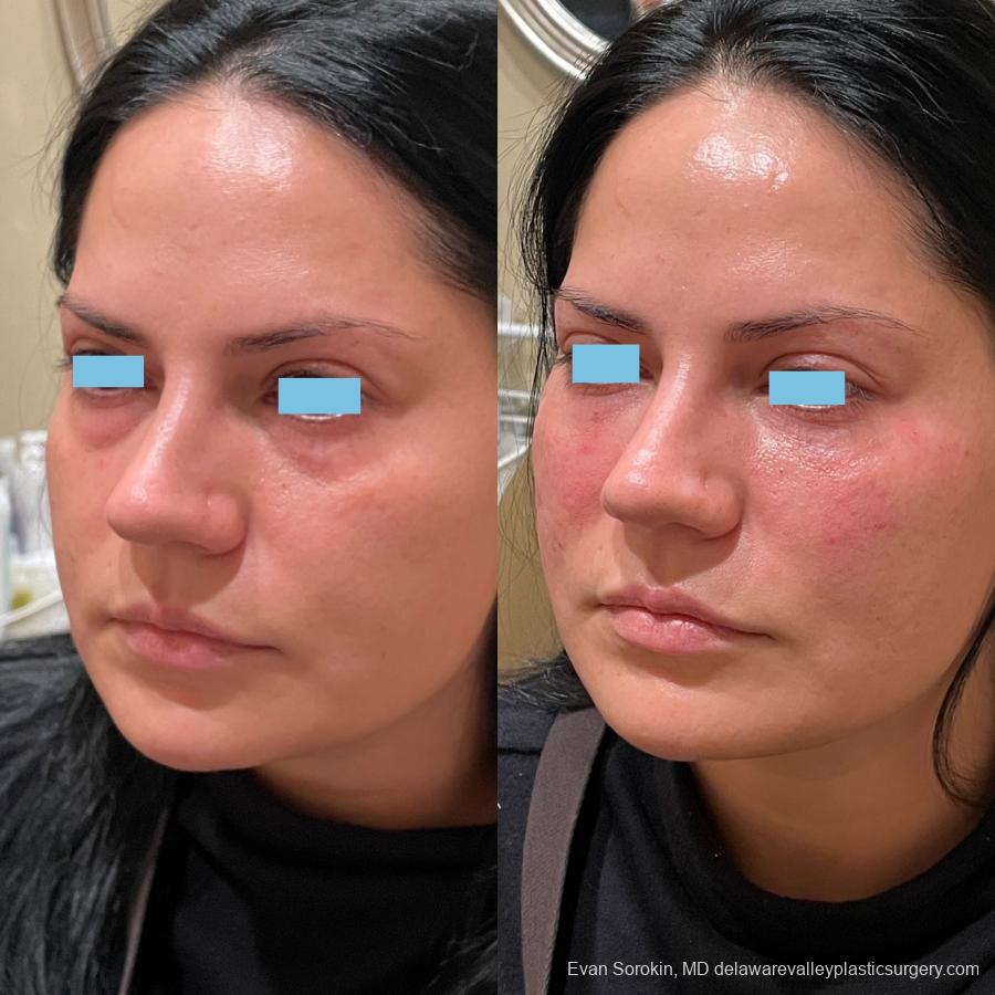 Fillers: Patient 19 - Before and After 3