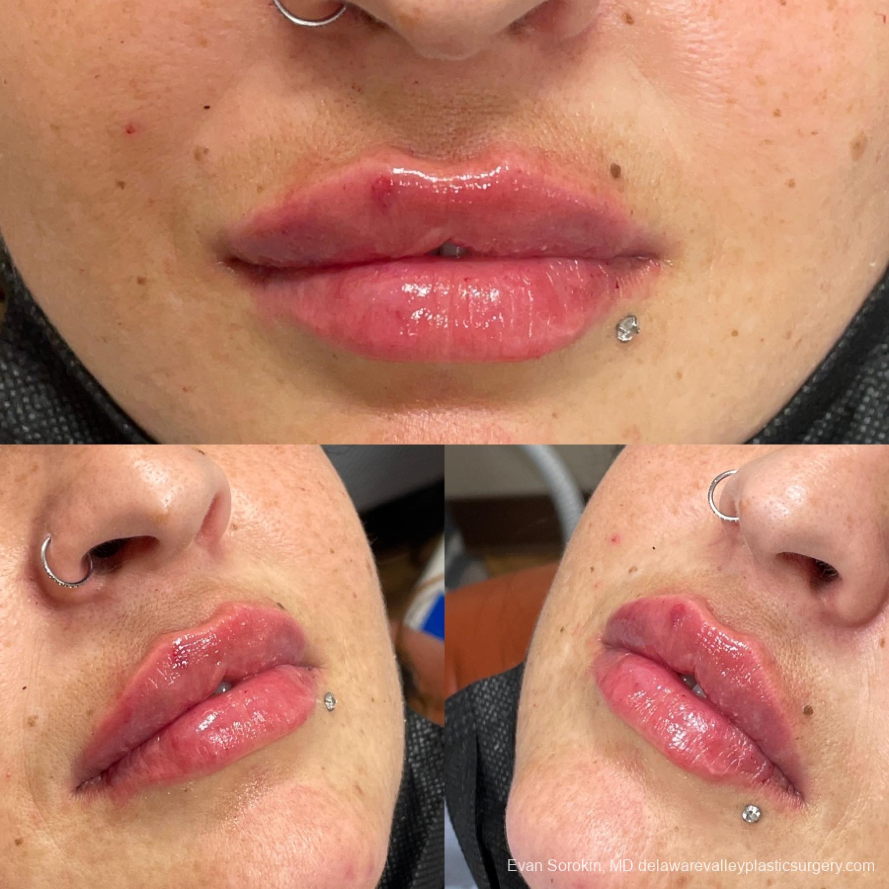 Lip Filler: Patient 13 - Before and After 2