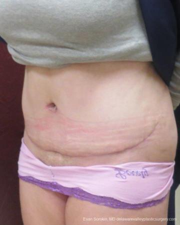 Philadelphia Abdominoplasty 9267 - After Image 4