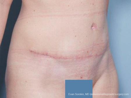 Philadelphia Abdominoplasty 9476 - After Image 2