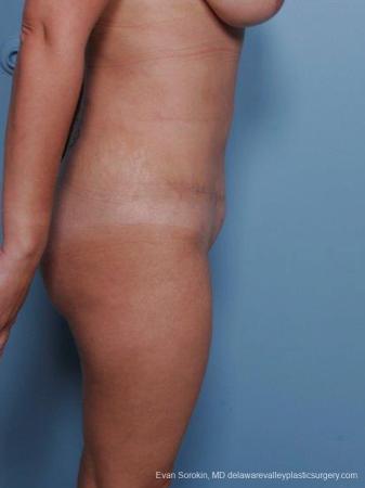 Philadelphia Abdominoplasty 9460 - After Image 3