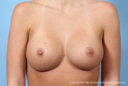 Philadelphia Breast Augmentation 8772 - After Image 1