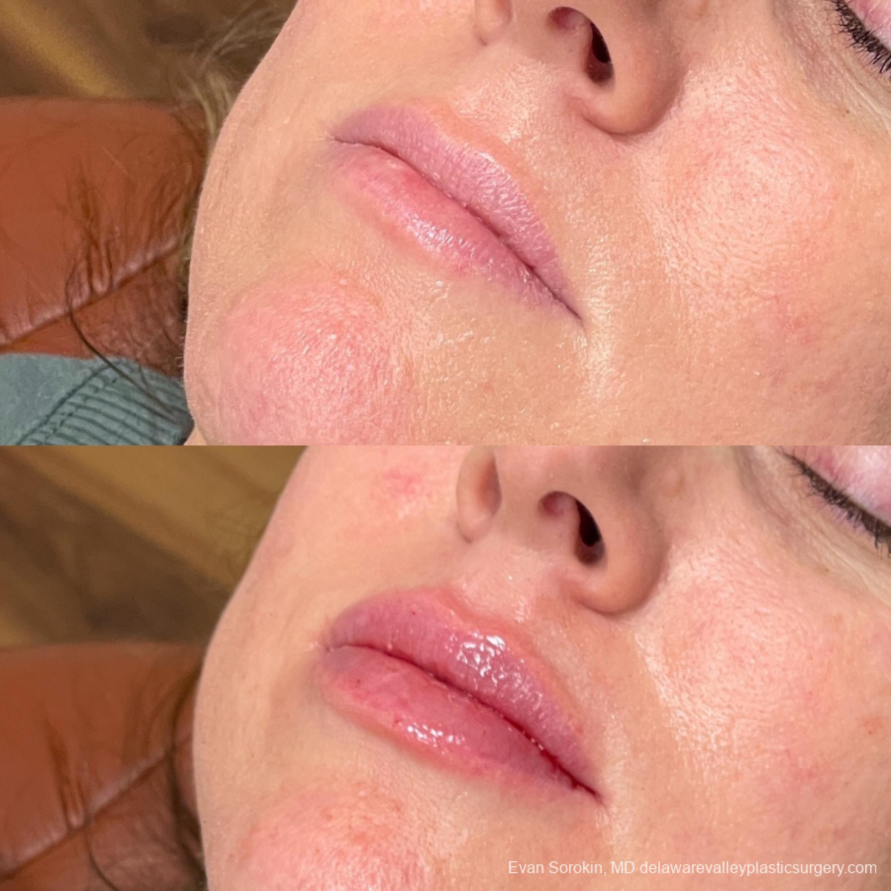 Lip Augmentation: Patient 65 - Before and After 3