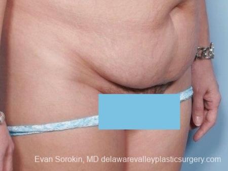 Philadelphia Abdominoplasty 8672 - Before Image 2