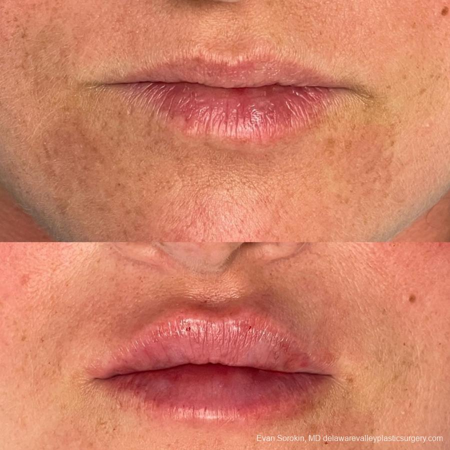 Lip Filler: Patient 61 - Before and After 1