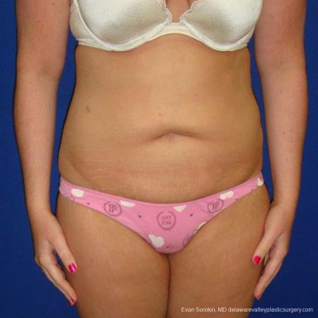 Philadelphia Liposuction 9484 - After Image 1