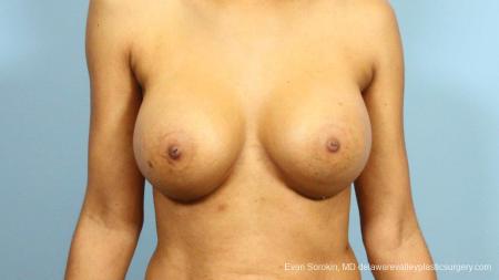 Philadelphia Breast Augmentation 9288 - After Image 1