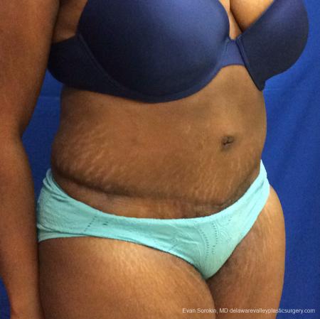 Philadelphia Abdominoplasty 10817 - After Image 2