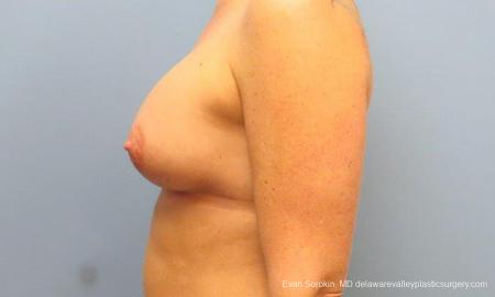 Philadelphia Breast Augmentation 9487 - After Image 5