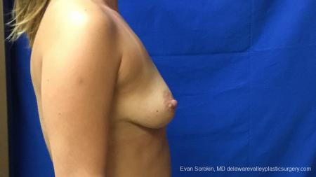 Philadelphia Breast Augmentation 13173 - Before Image 3
