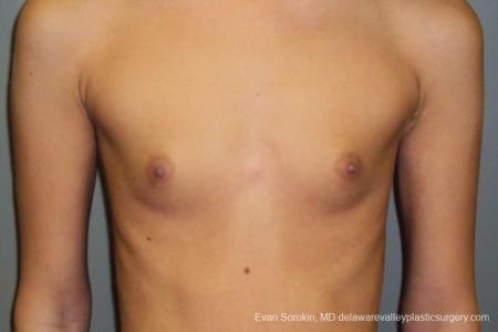 Philadelphia Breast Augmentation 8668 - Before Image 1