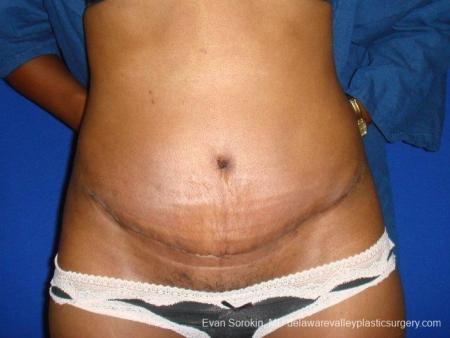 Philadelphia Abdominoplasty 8707 - After Image 1