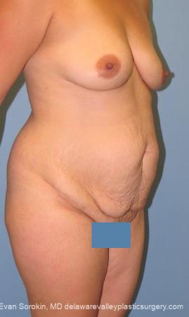 Philadelphia Mommy Makeover 10121 - Before Image 2