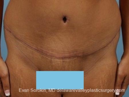 Philadelphia Abdominoplasty 8700 - After Image 1