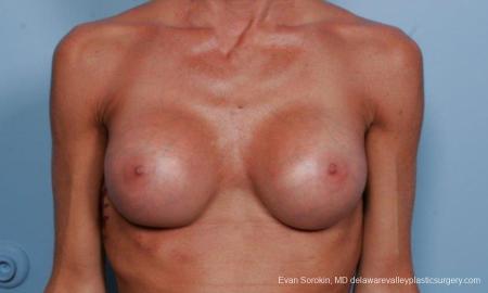 Philadelphia Breast Augmentation 8656 - After Image 1