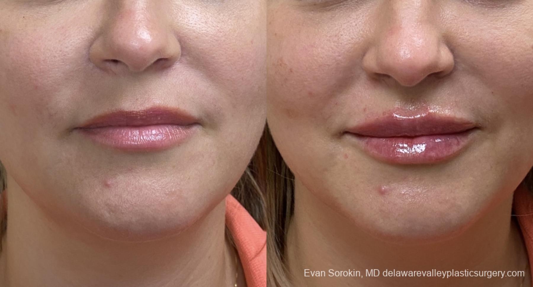 Lip Augmentation: Patient 22 - Before and After 