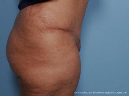 Philadelphia Abdominoplasty 9462 - After Image 3