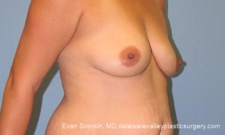 Philadelphia Breast Lift and Augmentation 10123 - Before Image 2