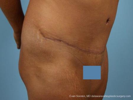 Philadelphia Abdominoplasty 9471 - After Image 2