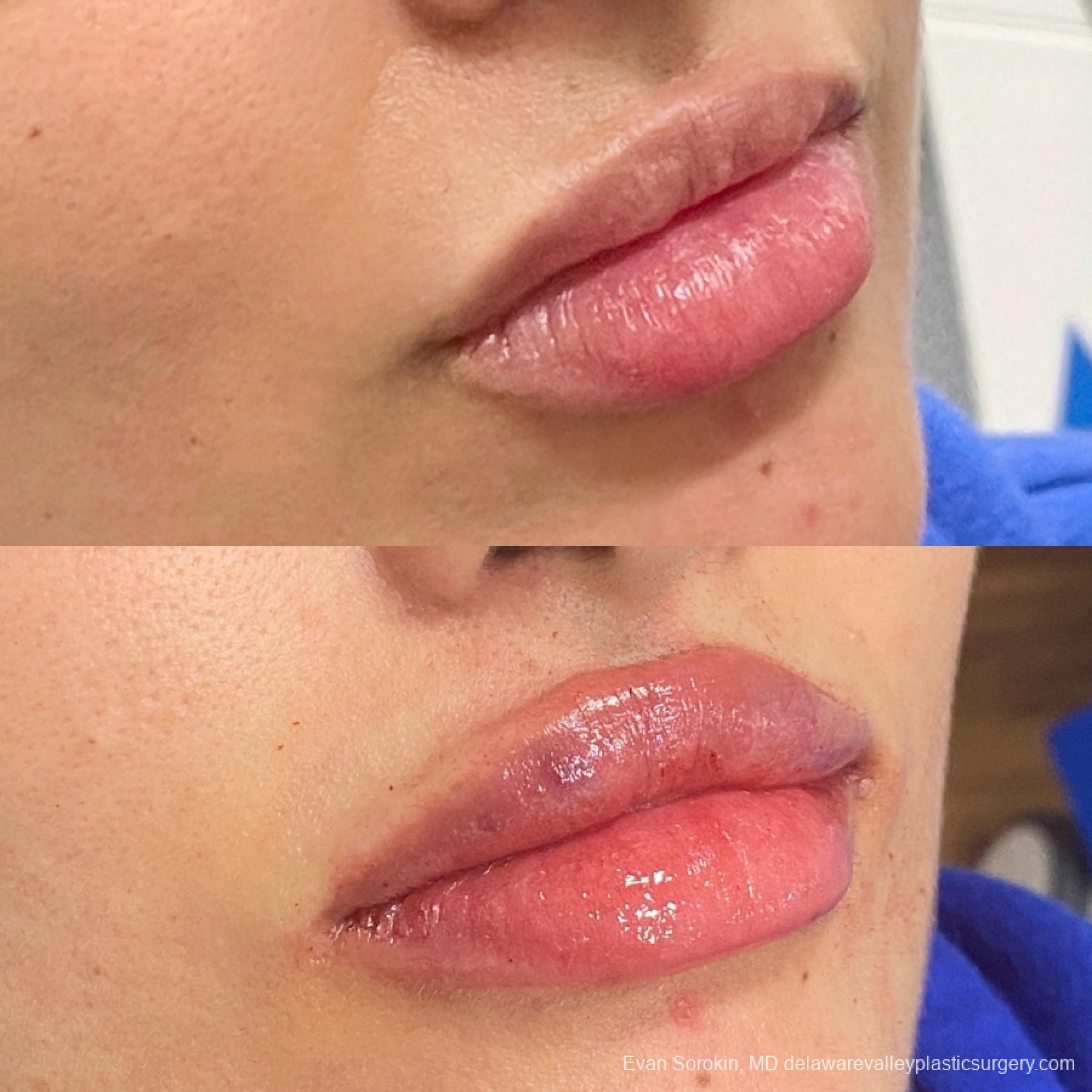Lip Filler: Patient 1 - Before and After 2